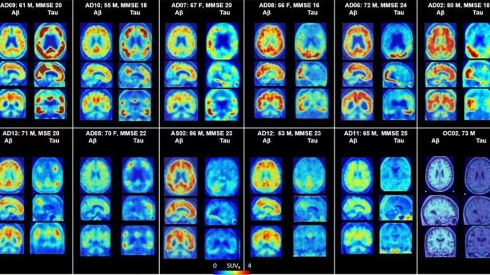 Enfermedad de Alzheimer-Variantes