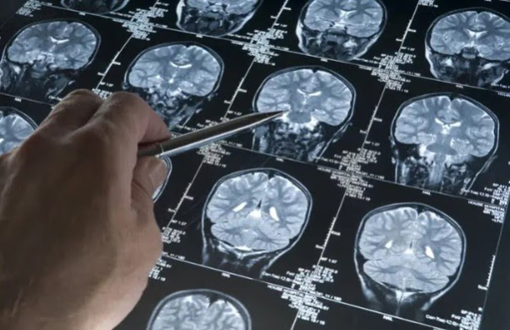 La variante APOE ε4 se asocia con un mayor riesgo de Alzheimer